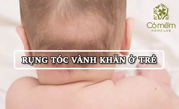 Rụng tóc vành khăn là gì? Cách điều trị hiệu quả